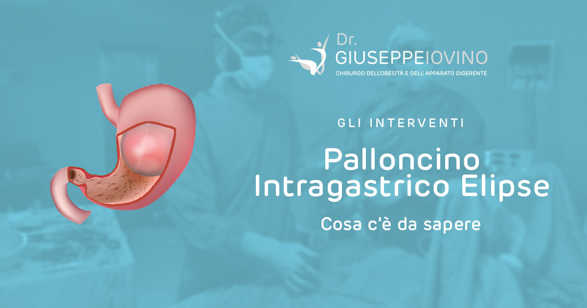 Palloncino Gastrico Elipse - Giuseppe Iovino