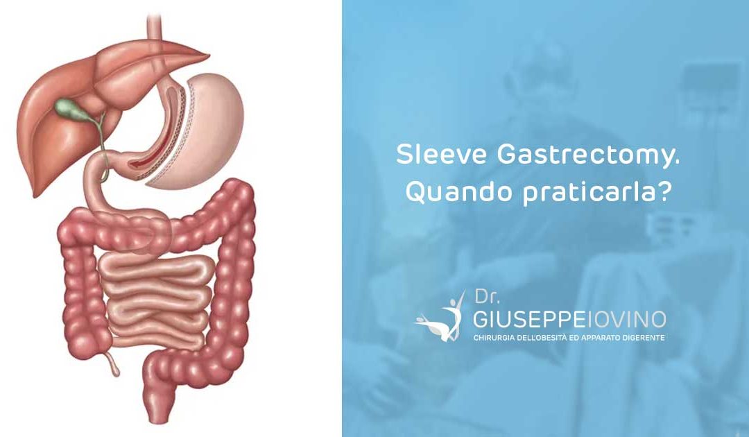 Sleeve Gastrectomy: quando praticarla?