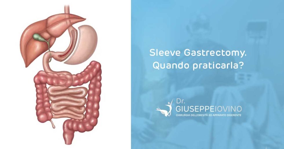 Sleeve Gastrectomy quando praticarla? Giuseppe Iovino