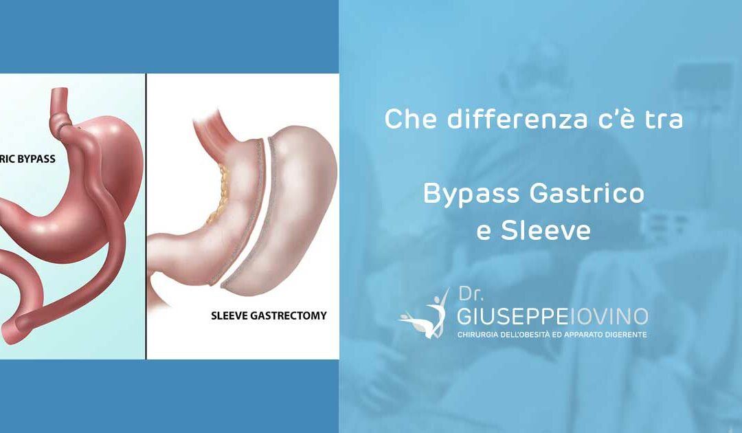 Che differenza c’è tra sleeve e bypass gastrico?