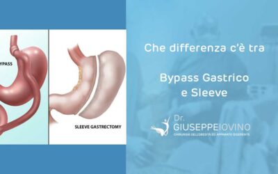 Che differenza c’è tra sleeve e bypass gastrico?