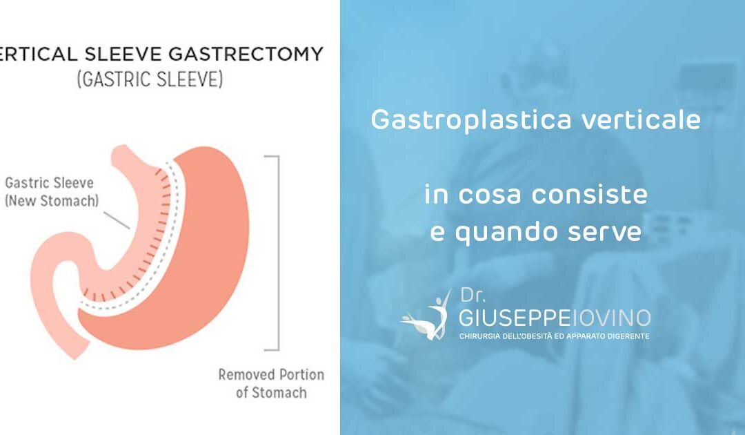 Gastroplastica verticale: in cosa consiste e quando serve