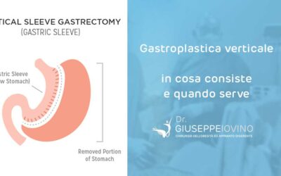 Gastroplastica verticale: in cosa consiste e quando serve