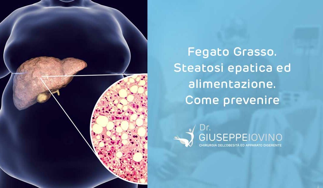 Steatosi epatica alimentazione: come prevenire il fegato grasso