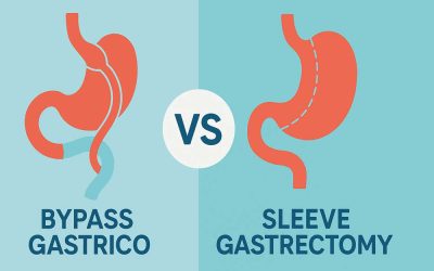Bypass gastrico vs Sleeve gastrectomy: quale scegliere nel 2025?