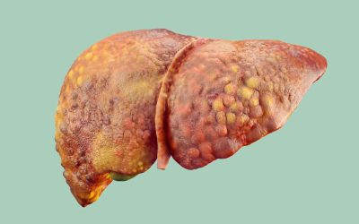 Fegato Grasso e Obesità: Come Invertire la NAFLD Senza Farmaci