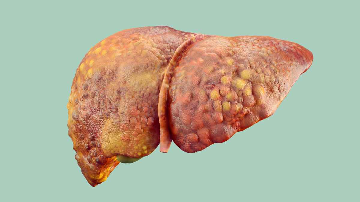 Fegato grasso obesità NAFLD reversibile con perdita peso