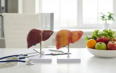 MASH (ex NASH): cos’è la steatoepatite metabolica e come si cura