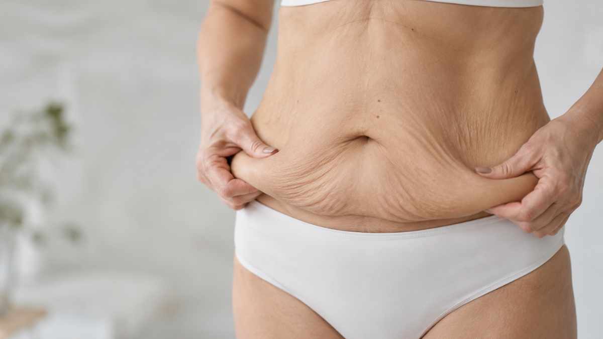 Chirurgia ricostruttiva post bariatrica: eliminazione della pelle in eccesso dopo importante calo ponderale