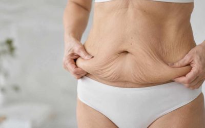 Chirurgia ricostruttiva post bariatrica: eliminare la pelle in eccesso dopo il dimagrimento